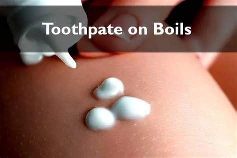 Toothpaste On Boils