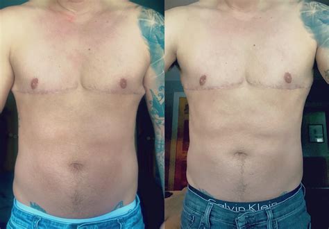 top surgery dog ears