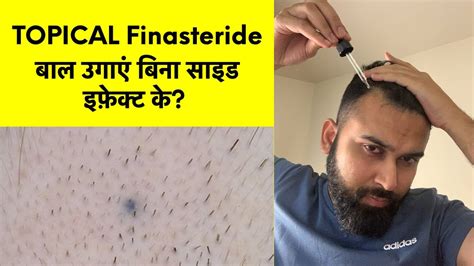 topical finasteride less side effects