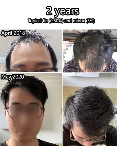 topical finasteride women reddit