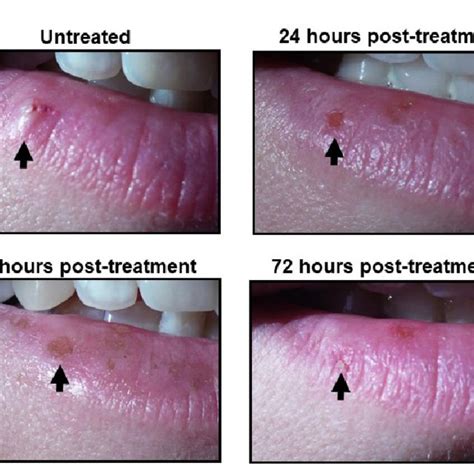 topical treatment for hsv 2