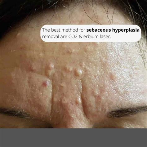 topical treatment for sebaceous hyperplasia
