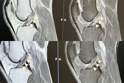 torn acl healing without surgery