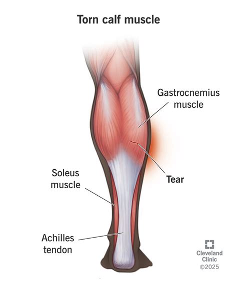 Understanding and Managing a Torn Calf Muscle: Causes, Symptoms, and Effective Recovery Strategies