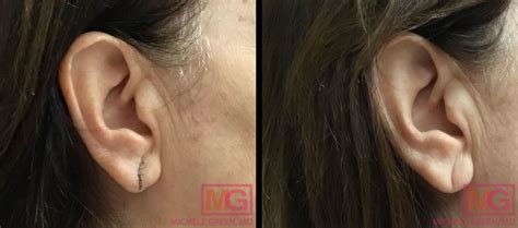 Torn earlobe close up