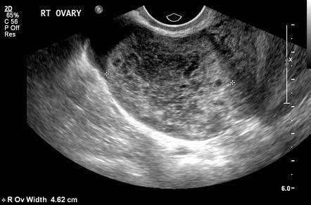 torsion detorsion ovary radiology