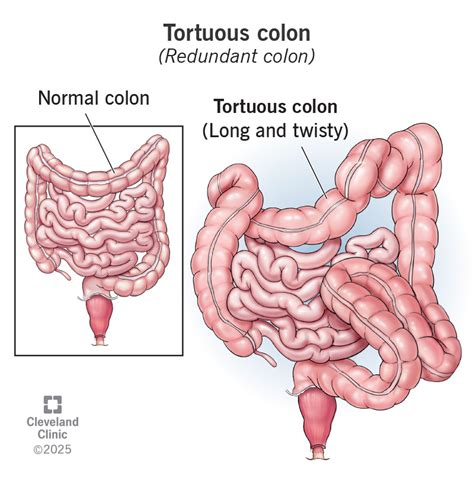 tortuous colon