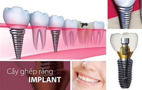 trồng răng implant giá rẻ parkway