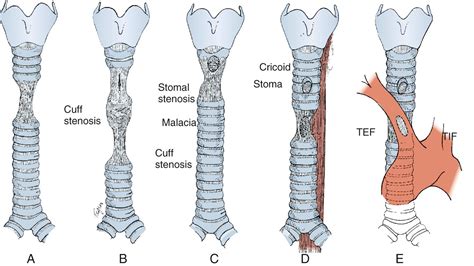 Trachea Unscramble