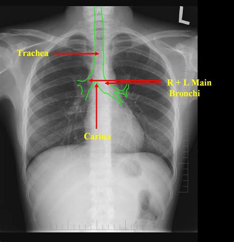 Trachea X Ray Lateral