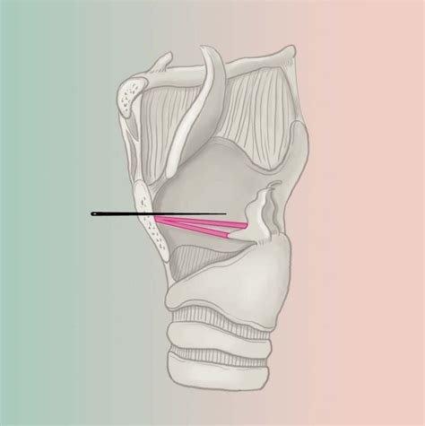 Tracheal Shave Anesthesia