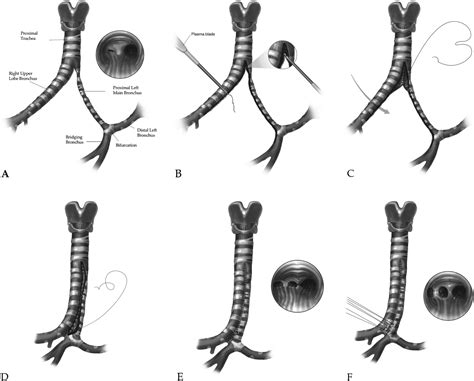Tracheobronchial Stenosis