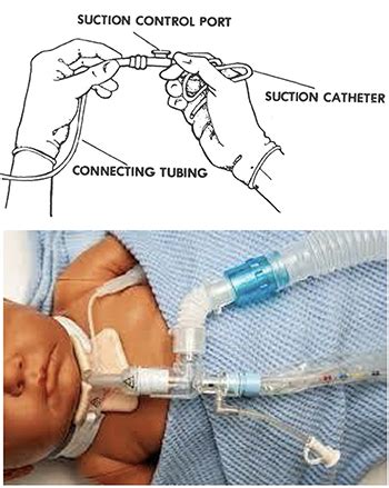 Tracheobronchial Suctioning Procedure