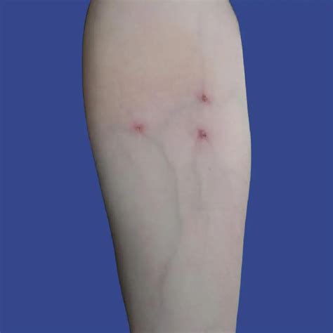 Track Marks From Stitches