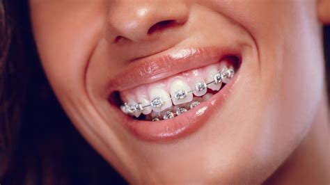 Train Tracks Braces Cost