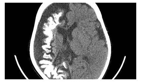 Tram Track Sturge Weber Syndrome Radiology Neuroradiology On The Net (SWS)