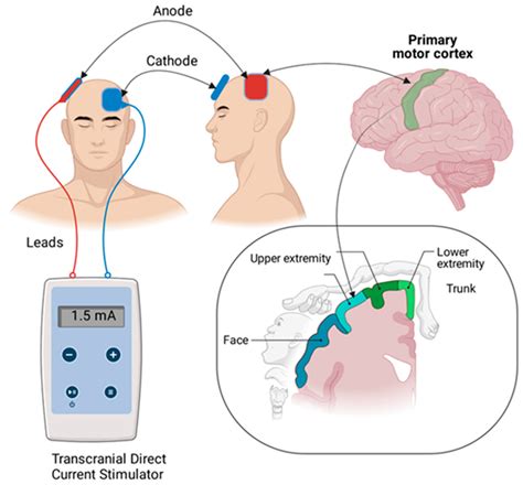 transcranial direct current stimulation for ocd
