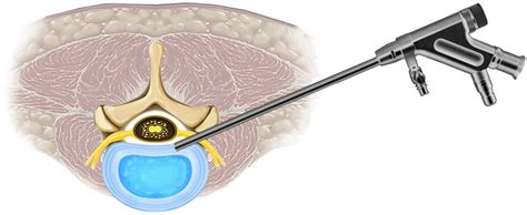 transforaminal endoscopic discectomy cpt code