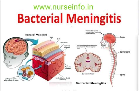 transmission of bacterial meningitis