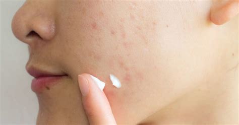 tratamiento para las manchas del acne