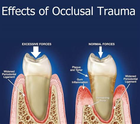 Traumatic Occlusal Forces