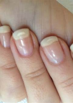 Treat Nails After Acrylics: Tips For Healthy And Beautiful Nails