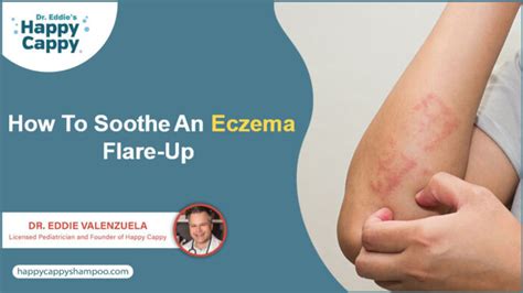 Treating Eczema Flare Ups
