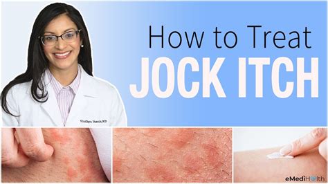 Effective Ways to Get Rid of Jock Itch: A Comprehensive Guide to Treating Jock Itch Quickly and Easily