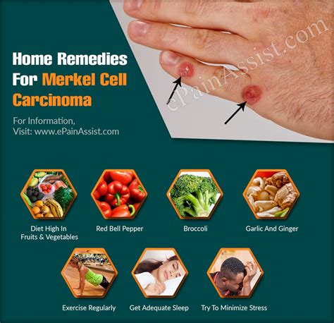 Home Remedies For Merkel Cell Carcinoma