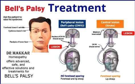 treatment for bell palsy