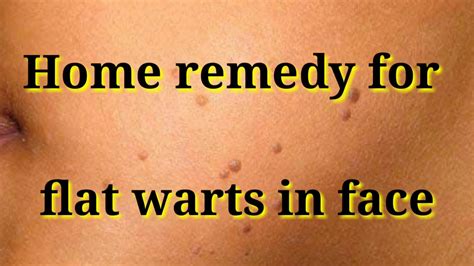 treatment for flat warts