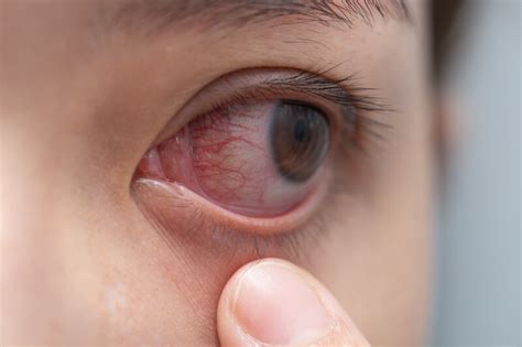treatment for herpes eye infection