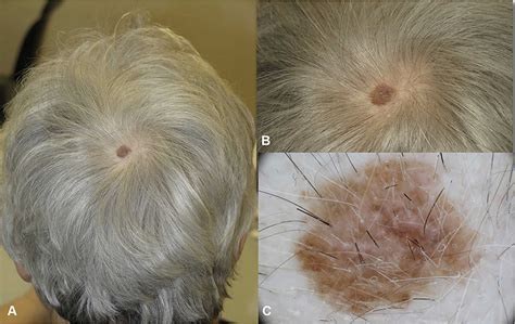 treatment for melanoma on scalp