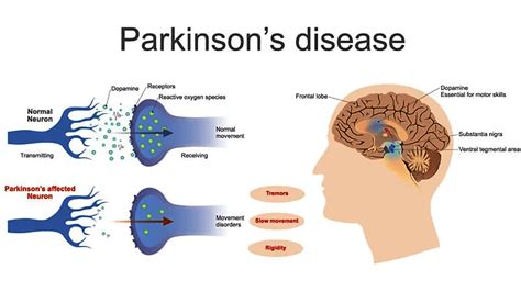 treatment for parkinson's disease dopamine