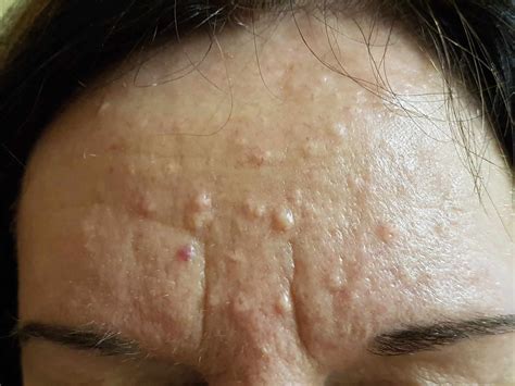 treatment for sebaceous hyperplasia on face