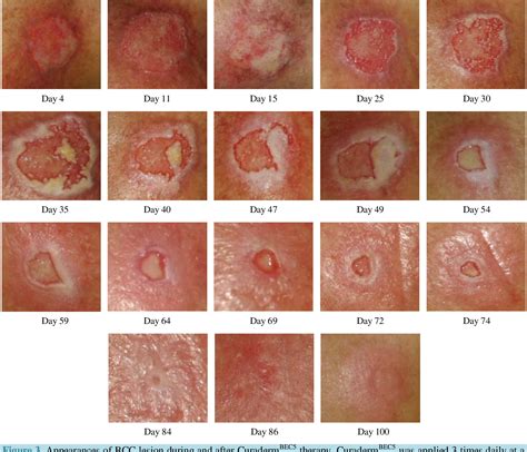 treatment for skin melanoma