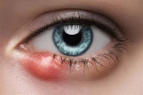 treatment for stye on lower eyelid surgery