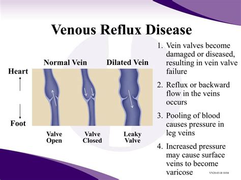 treatment for venous reflux disease