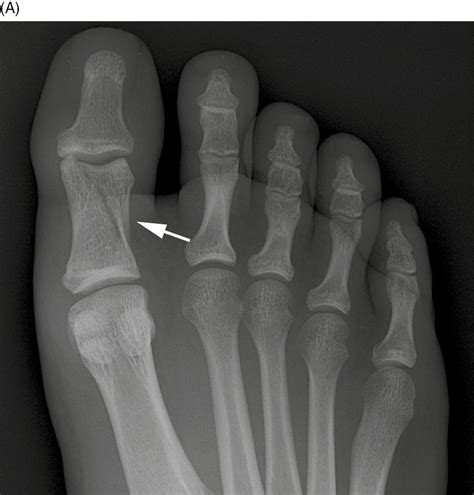 Treatment Fracture Big Toe