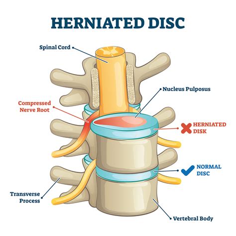 Effective Treatment Herniated Disc Options: Relieve Pain and Speed Recovery