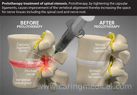 treatment lumbar spinal stenosis