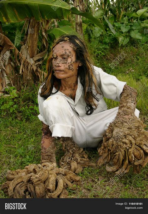 The Mysterious "Tree Man" Of Indonesia