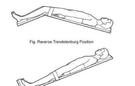 trendelenburg position vs reverse