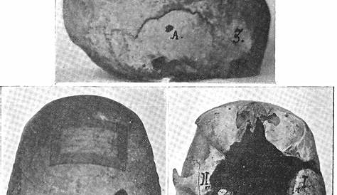 Trepanation Prehistoire 6500 Avant J.C. La Trépanation Dossier