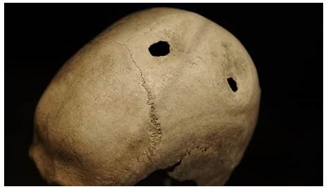 Trepanation The History of One of the World's Oldest