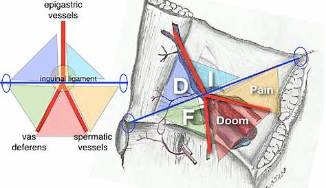 Triangle Of Doom Anatomy Essentials For Laparoscopic Inguinal Hernia Repair