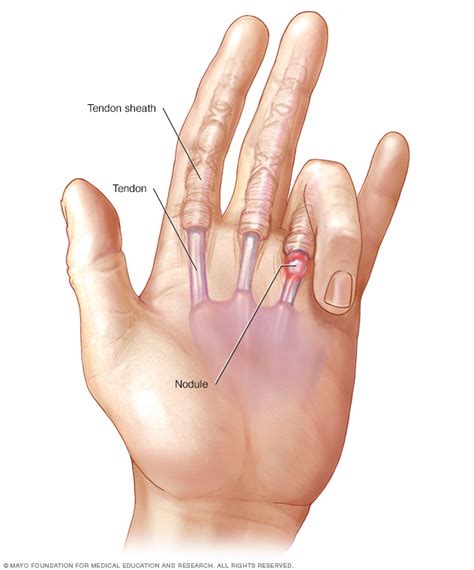 Trigger Finger Caused By Medication