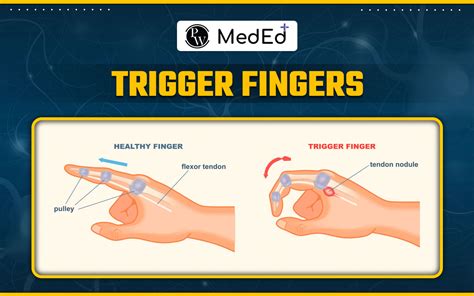 Trigger Finger Effects