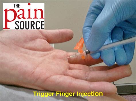 Trigger Finger Injection Cpt Code Aapc