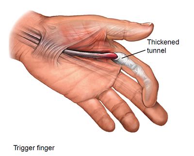 Understanding Trigger Finger Medical Procedure: Causes, Benefits, and Recovery